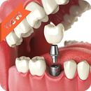 Diş implantları APK