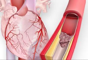 symptômes d'une crise cardiaque capture d'écran 1