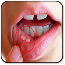 Remove a Mouth Ulcer APK