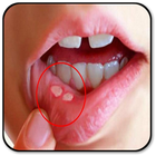 Remove a Mouth Ulcer ikon