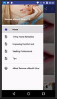 Remove a Mouth Ulcer penulis hantaran