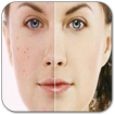 Acne Free Face