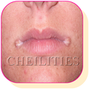How to treat Angular Cheilitis at Home Naturally APK