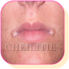 How to treat Angular Cheilitis at Home Naturally icône