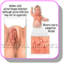 APK Home remedies for Genital herpes infection