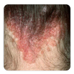 scalp psoriasis guide