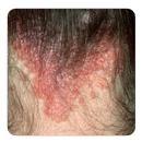 scalp psoriasis guide APK