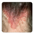 scalp psoriasis guide icon