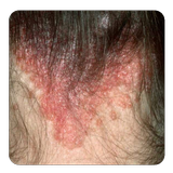 scalp psoriasis guide icon