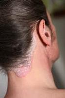 scalp psoriasis guide poster