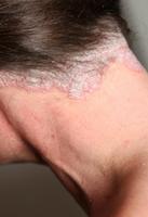 scalp psoriasis guide screenshot 1