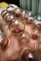 cupping hijama guide poster