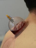 cupping hijama guide screenshot 1