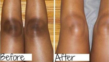 Bleaching the knees screenshot 1