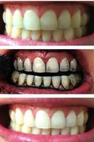 teeth whitening naturally tips पोस्टर