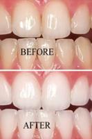 teeth whitening naturally tips تصوير الشاشة 1