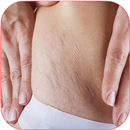 to Get Rid of Stretch Marks APK