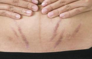 to Get Rid of Stretch Marks gönderen
