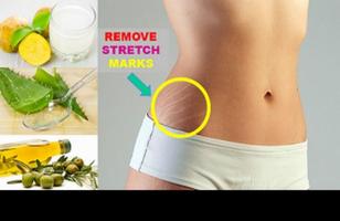 to Get Rid of Stretch Marks Ekran Görüntüsü 1