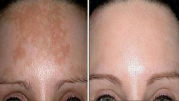 Home Remedies for Age Spots gönderen