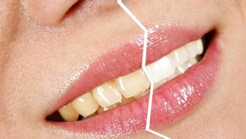 Home Remedies for Yellow Teeth постер