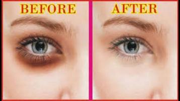 Dark Circles under the Eyes постер