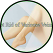 varicose veins guide