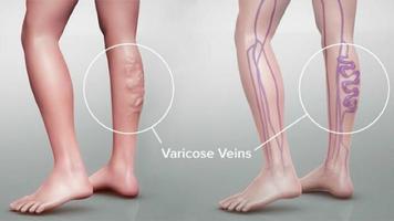 varicose veins gönderen