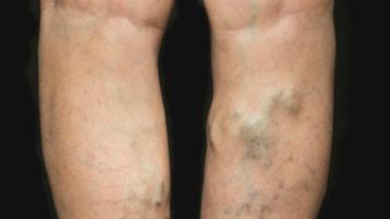 varicose veins Ekran Görüntüsü 1