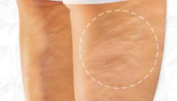 tips Cellulite in Thighs постер
