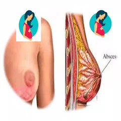 Breast mastitis and treatment APK download