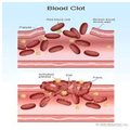 Hemophilia