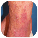 Eczema in the skin APK