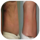 belly cellulite APK