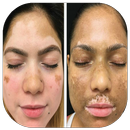 Natural cure for vitiligo APK