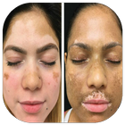 Natural cure for vitiligo icon