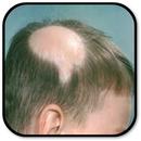 How to get rid of Alopecia APK