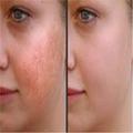 Laser Skin Resurfacing