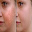 Laser Skin Resurfacing APK