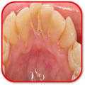 How to Prevent Tartar