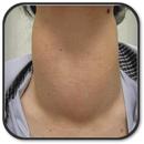 How to Prevent Thyroid Cancer APK