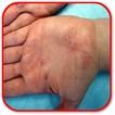 How to Treat Syphilis
