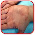 How to Treat Syphilis