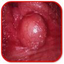 How to Treat Vaginal Cysts APK