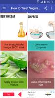 How to Treat Vaginal Cysts 截图 1