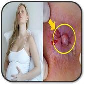 Hemorrhoids during pregnancy pour Android - Téléchargez l'APK Hemorrhoids during pregnancy pour Android - Téléchargez l'APK