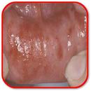 How to Heal Mouth Inflammation APK