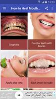How to Heal Mouth Inflammation โปสเตอร์