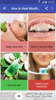 How to Heal Mouth Inflammation ภาพหน้าจอ 1