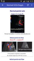 Doppler in Liver Transplant syot layar 3